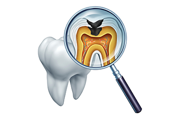 大切な歯を残すために、こんな症状は早めに根管治療を受けましょう