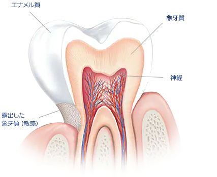 歯がキーンとしみることありませんか？