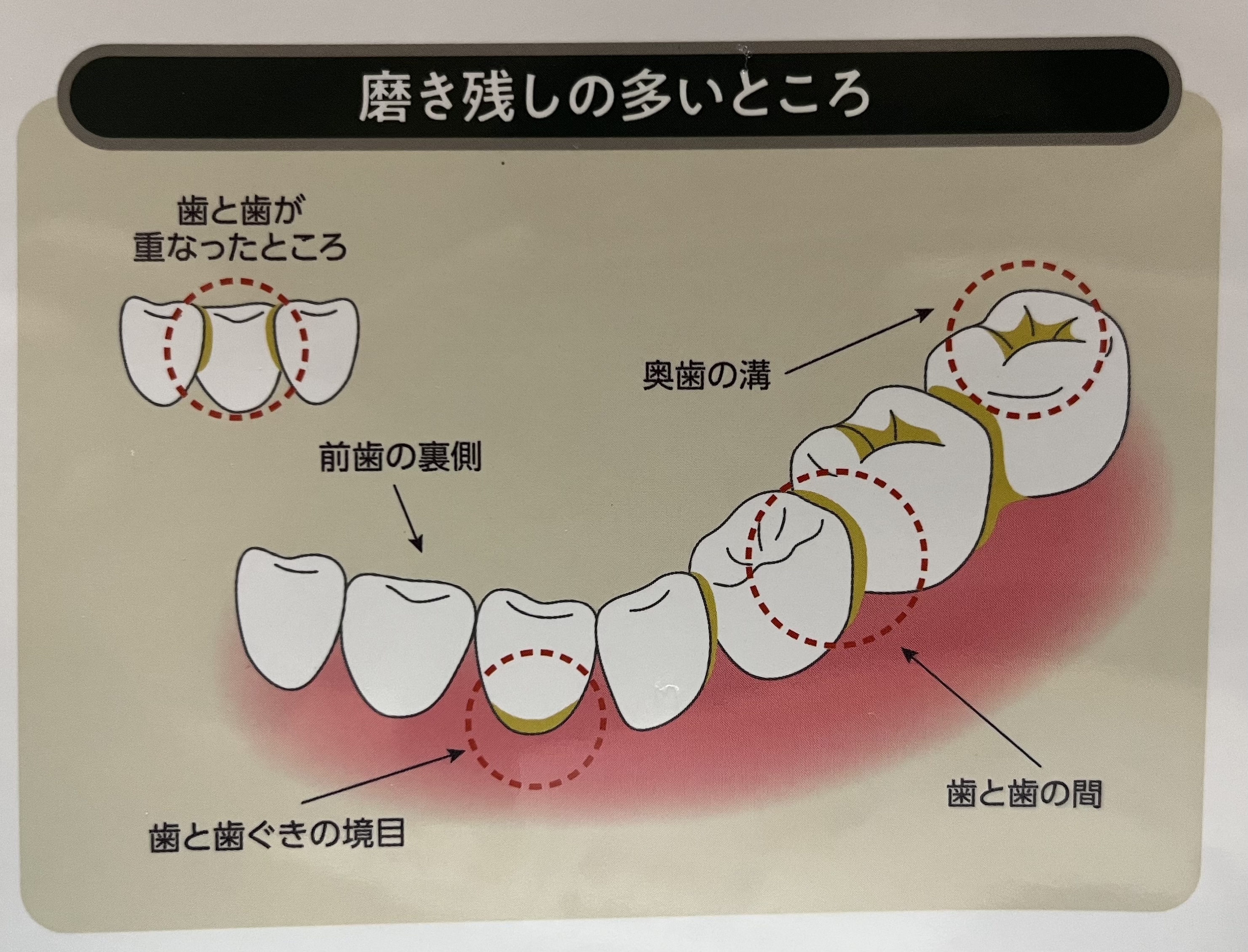 虫歯の好発部位