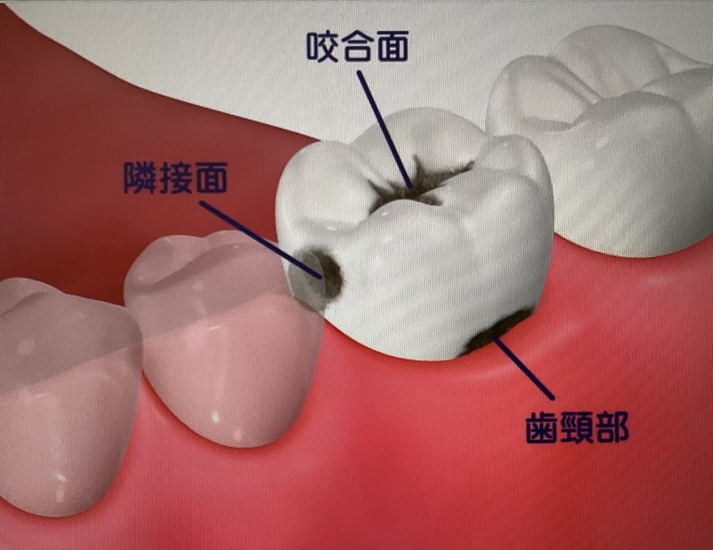 虫歯になりやすいところ