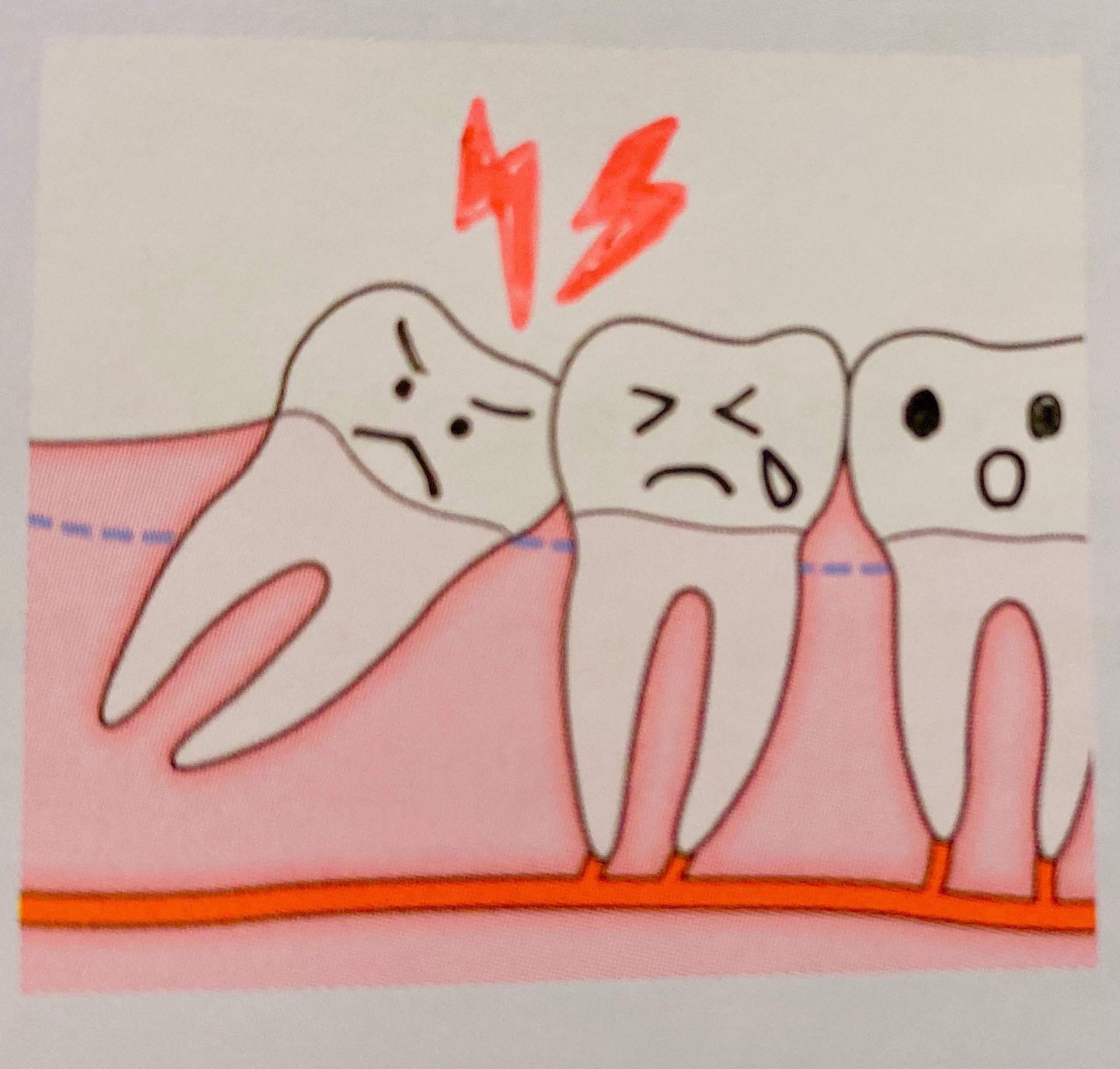 親知らず抜歯