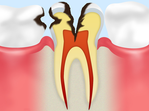 C3【神経にまで達した虫歯】