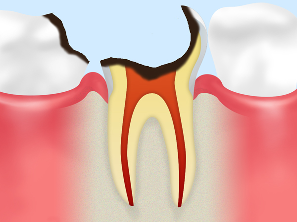 C4【歯根にまで達した虫歯】