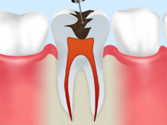 歯の根の治療