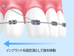 歯科矯正用アンカースクリューを用いた矯正歯科治療