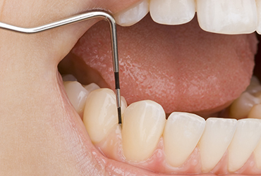 成人の約80％が歯周病予備軍またはすでに発症しています